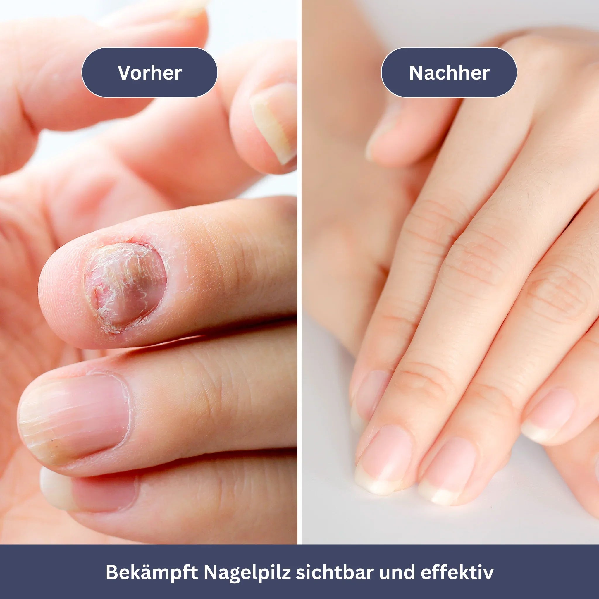 NailDrops – Care Serum for Nail Fungus