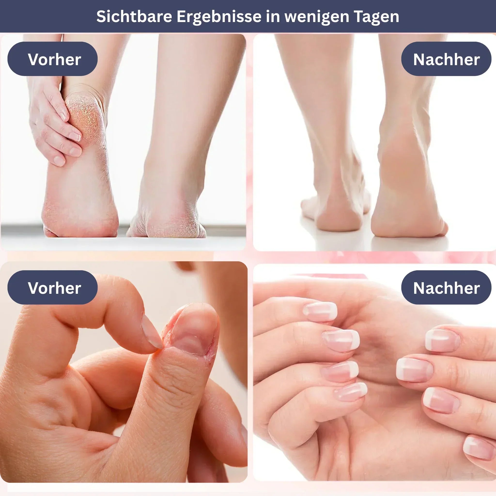 SamtFuß Pro – Electric Callus Remover